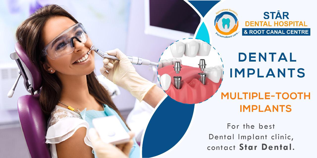 Important Things you Must know about dental implants Best Dental Important Things you Must know about dental implants Best Dental