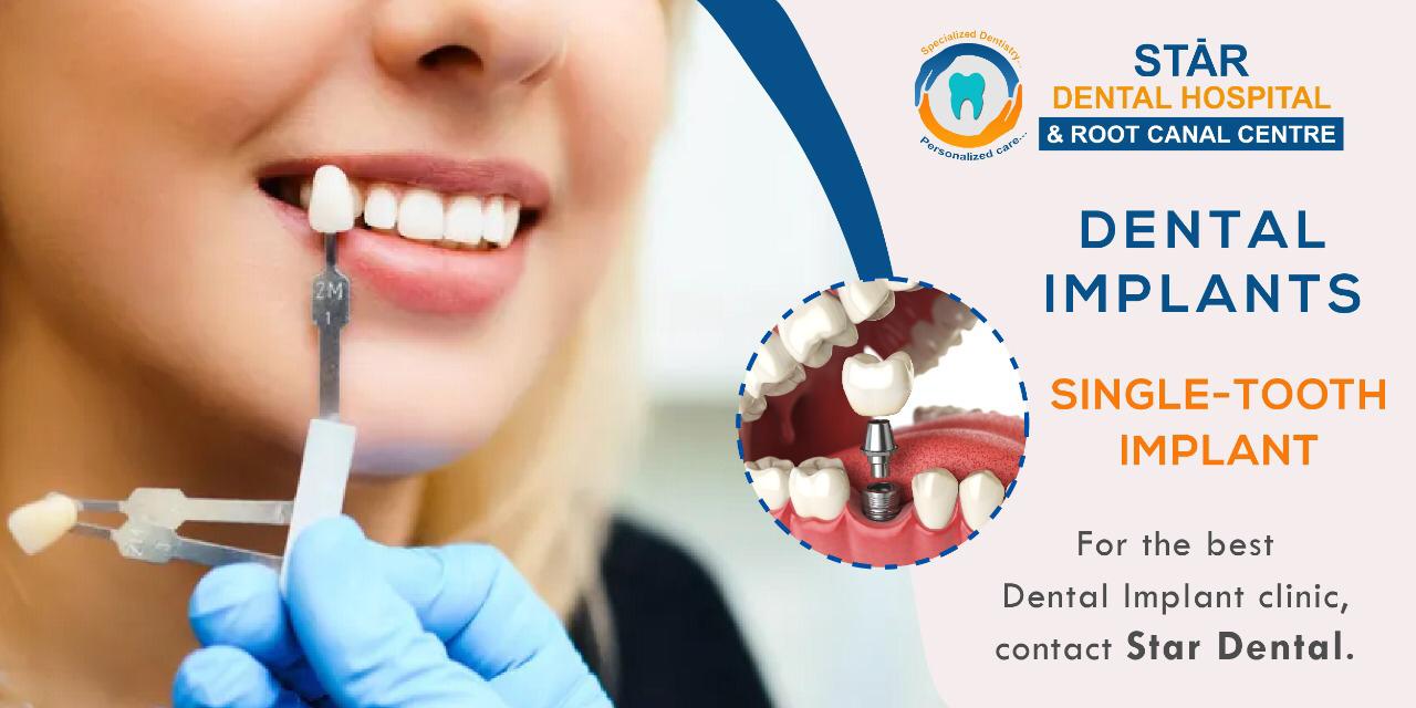 Dental Implants Things You Need To Know Star dental Hospital Tirupati Dental Implants Things You Need To Know Star dental Hospital Tirupati